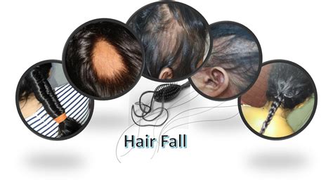 Hair Fall – INSTITUTE OF APPLIED DERMATOLOGY | Blog