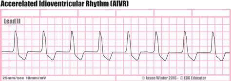 ECG Educator Blog : Ventricular Rhythms