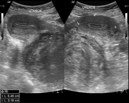 [31+] Uterine Fibroids Ultrasound Appearance