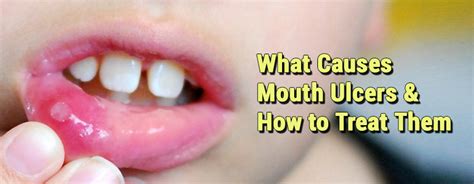 What Causes Mouth Ulcers and How to Treat Them