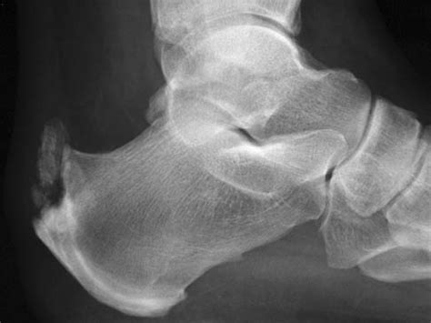 Achilles Tendonitis - Foot & Ankle - Orthobullets