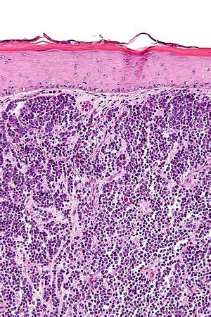 Merkel cell carcinoma - Libre Pathology