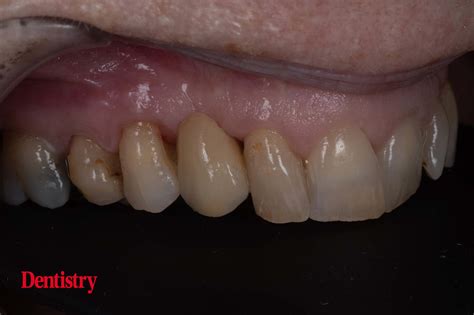 Prosthodontips – resin-retained bridges: fun and predictable - Dentistry