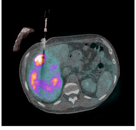 Evaluation of a large liver lesion in a 46-year-old male patient, with ...