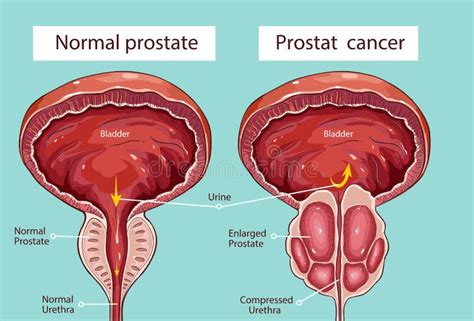 Normale Prostata Und Akute Prostatitis Medizinische Illustration Vektor ...