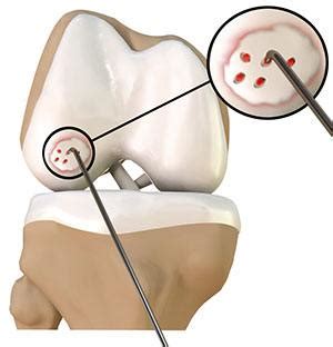 Chondroplasty Grayslake, IL | Cartilage Injury Lincolnshire, IL