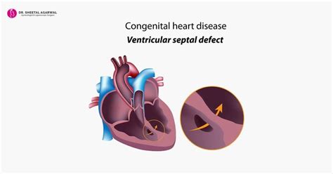 Congenital Heart Defect - Know What It Is and Save Your Unborn Child - Dr Sheetal Agarwal