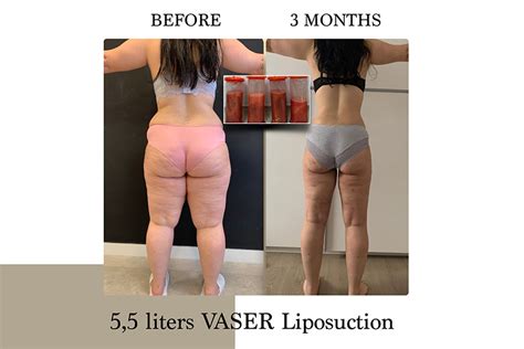 Lipedema | Before & After