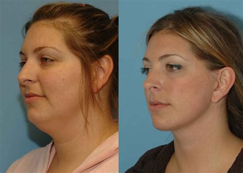 Neck liposuction orange county 2, 2020 | Beverly hills