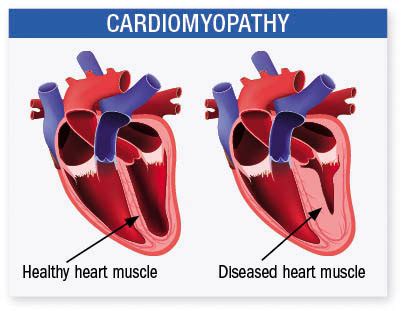 Possible causes of an enlarged heart - Harvard Health