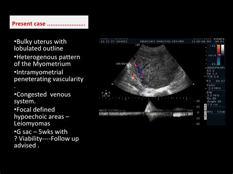 Adenomyosis and Pregnancy, Symptoms Signs and How Does Adenomyosis ...