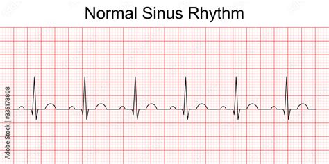 Electrocardiogram show normal heart beat line (Sinus rhythm). ECG. EKG. Vital sign. Medical ...