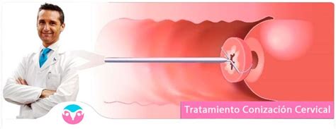 Cervical Conization & LEEP Treatments | Cervical Cancer Treatments | Dr. Lucas Minig