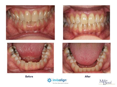 Invisalign Express for Minor Crowding