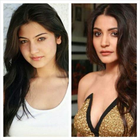 Anushka Sharma Plastic Surgery Rumors