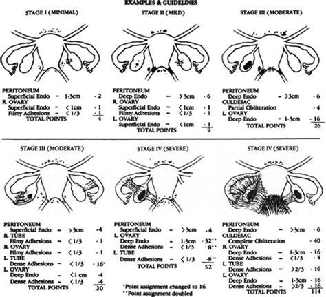 Endometriosis Stages - Endometriosis Stages And How They Are Measured - Maybe you would like to ...