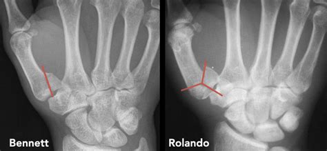 Bennett fracture • LITFL • Medical Eponym Library