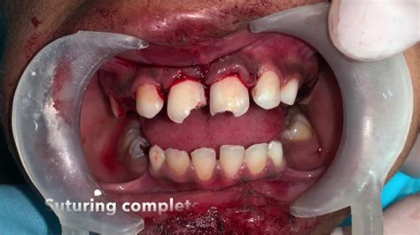 Teeth avulsion and reimplantation using orthodontic retention wire ...