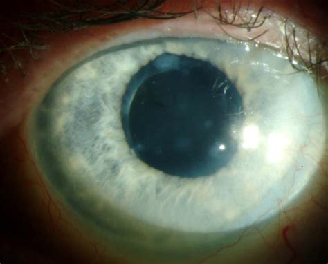 Salzmann's Nodular Corneal Degeneration: The University of Iowa ...