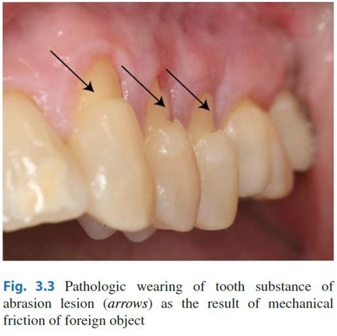 Dentosphere : World of Dentistry: Tooth Sensitivity / Dentin ...