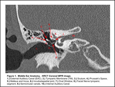 Prussak Space Ct Scan