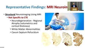 Boston University Alzheimer's Disease Research Center | VuMedi