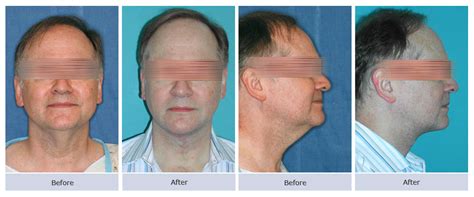 Submentoplasty Photos | Cosmetic Surgery NYC