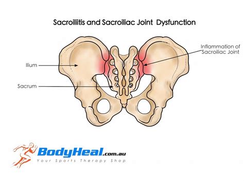 What Is Sacroiliitis & Sacroiliac Joint Dysfunction? Causes, Symptoms & Treatment Options in ...