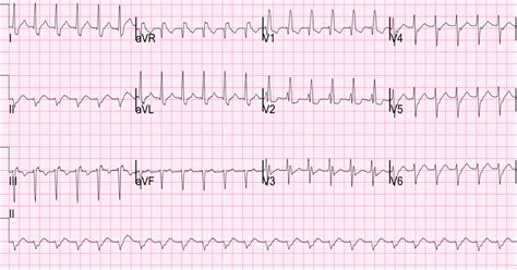 Dr. Smith's ECG Blog: Paroxysmal SVT (PSVT) that repeatedly recurs in spite of successful ...