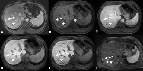 Distinguishing hemangiomas from metastases on liver MRI performed with gadoxetate disodium ...