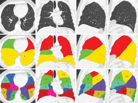 Figure 2 from Automatic Segmentation of Pulmonary Segments From ...