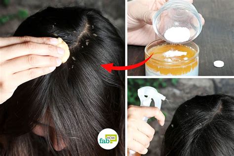 Apple Cider Vinegar for Dandruff: 8 Remedies That Really Work | Fab How