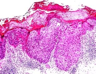 Bowen's Disease Causes