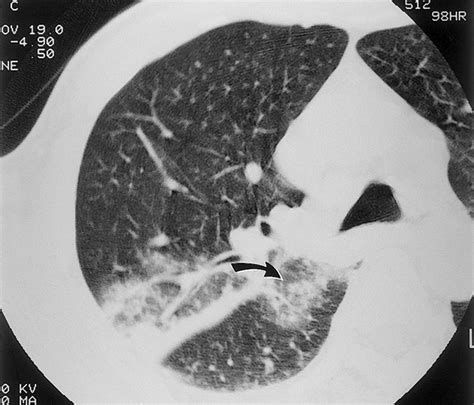 Radiographic and CT Appearances of the Major Fissures | RadioGraphics