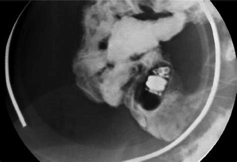 Small bowel follow through showing endoscopic capsule in terminal ileum. | Download Scientific ...