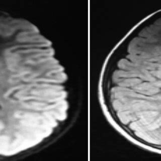 MRI brain FLAIR and diffusion-weighted image (DWI) after 5 months ...