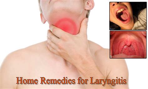 25 Home Remedies for Laryngitis - Home Remedies - Natural & Herbal Cures Made at HomeHome ...