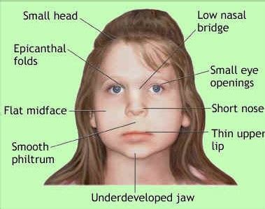 DiGeorge Syndrome- Causes, Symptoms And Treatment