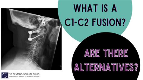 What Is the Success Rate of C1-C2 Fusion? - Centeno-Schultz