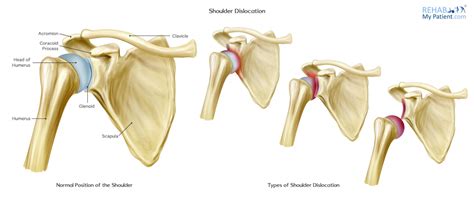 Shoulder Dislocation Types