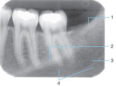 mandibular molar radiograph Diagram | Quizlet