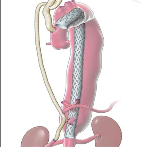 Dacron graft repair of ascending and descending aortic dissection ...