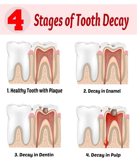 Understand Four Stages of #Tooth #Decay and How #Cavities are Caused ...