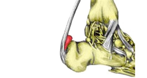 Achilles Bursitis | Retrocalcaneal Bursitis - Symptoms, Causes & Treatment