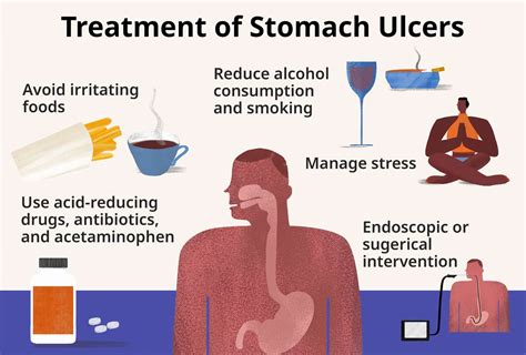 Stomach Peptic Ulcer Signs Symptoms Causes Treatment - vrogue.co