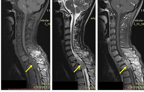 Spinal schwannoma – Radiology Cases