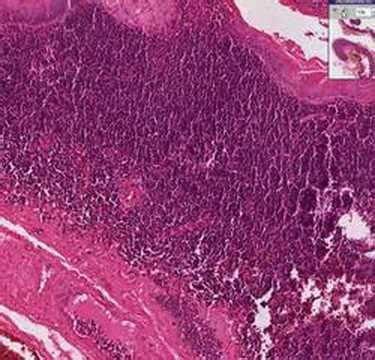 Branchial Cleft Cyst Histology