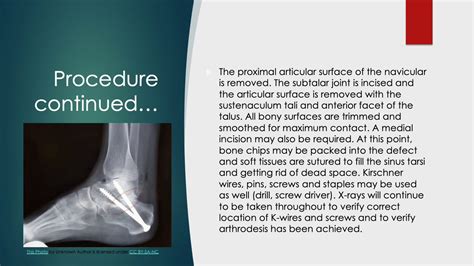 Triple Arthrodesis of the Ankle - YouTube