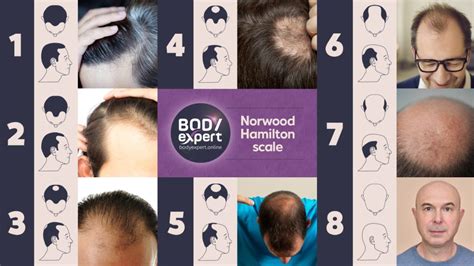 Norwood-Hamilton scale: the 7 stages of male pattern baldness