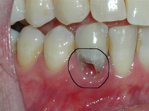 External and Internal Tooth Resorption - Dentist in Brampton, ON ...